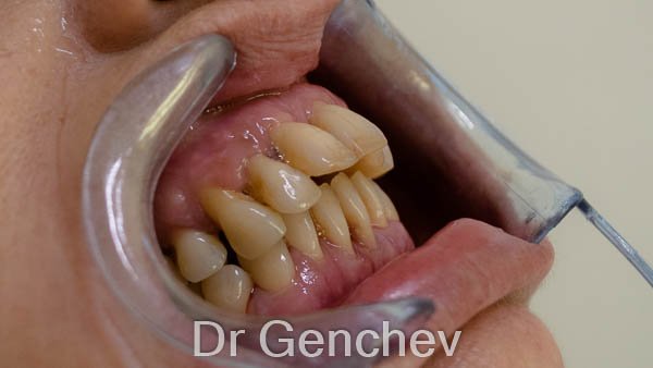 patient with gum disease