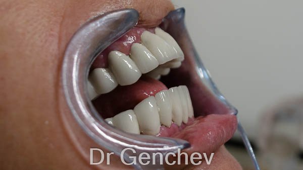patient with gum disease after basal dental implantation