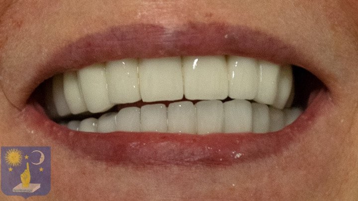 PFM dental ceramic bridge on basal dental implants