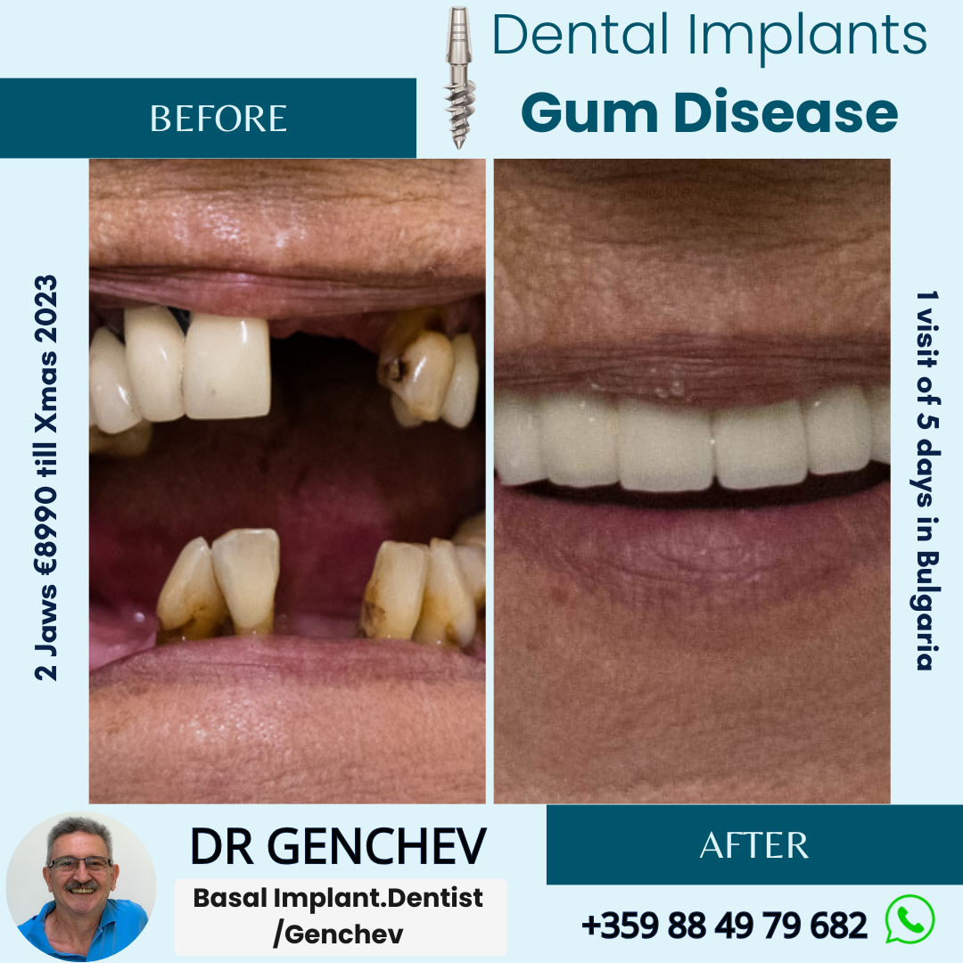 before and after photos for gum disease treatment with basal dental implants