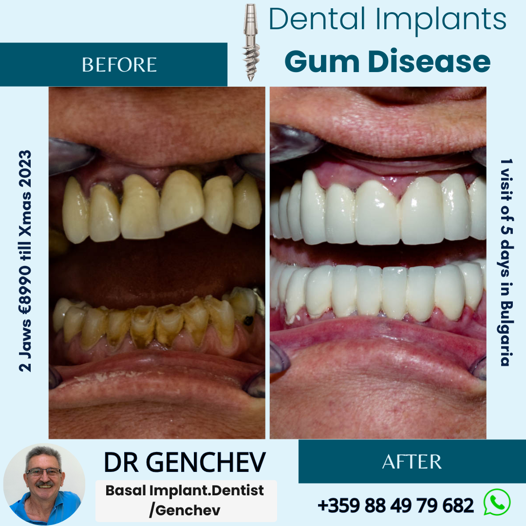 before and after gum disease treatment with basal dental implants
