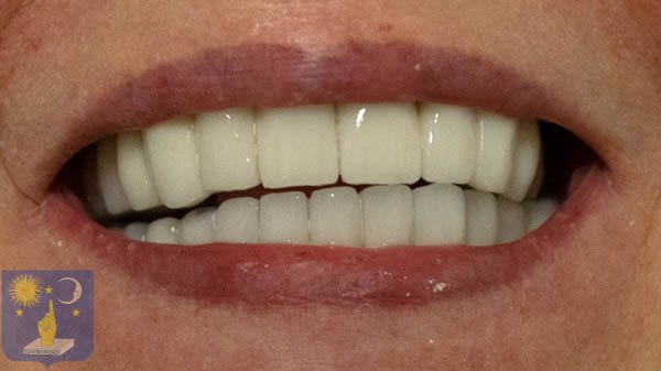 patient with gum disease after basal dental implants with PFM ceramic bridges