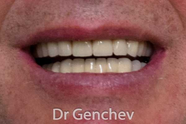 patient with bruxism after full dental restoration with basal implants