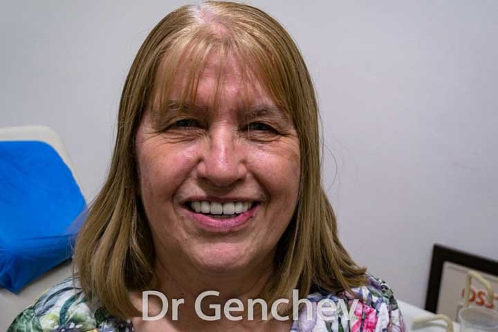 patient with gum disease after basal dental implants