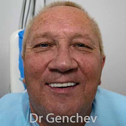 edentulous patient of Dr Genchev with new teeth on basal dental implants
