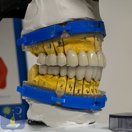 dental bridges in metal-ceramic for basal implants