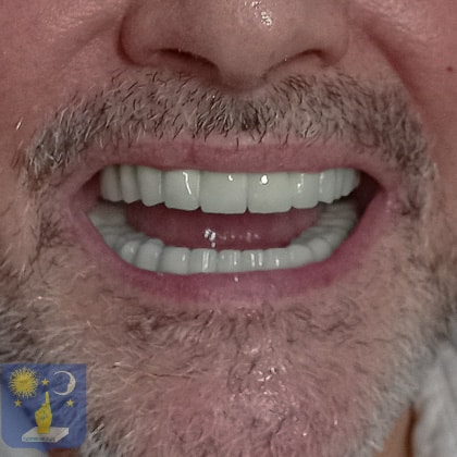 pfm metal ceramic bridge fixed prosthesis
