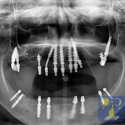 x-ray basal dental implants
