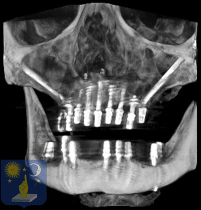 xray zygomatic and conventional dental implants