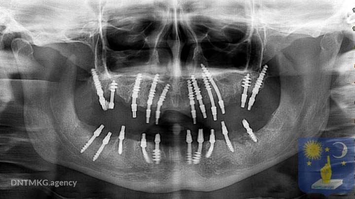 basal dental implants x-ray
