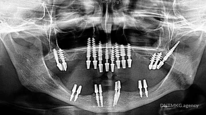 OPG x-ray of edentulous patient with full restoration with basal dental implants