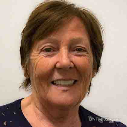 patient with periodontitis smiling after full dental restoration with basal implants