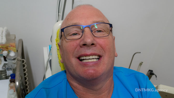 patient avec bruxisme pour implant basal