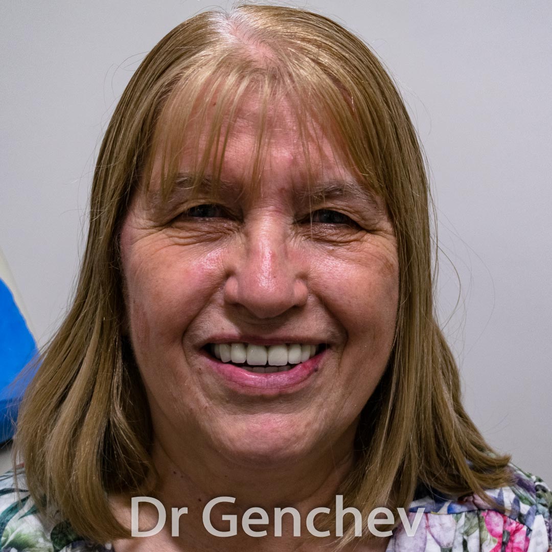 Veronique France periodontitis Dr Genchev basal implant