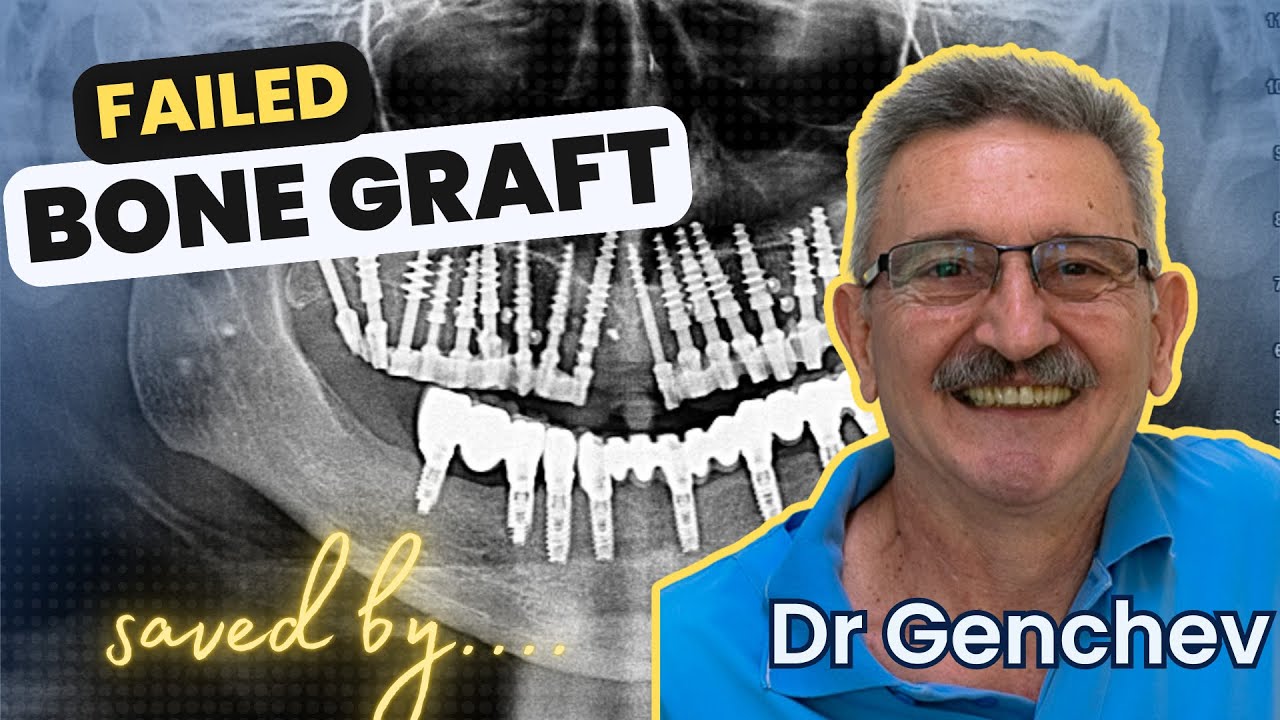 Watch the video of the case study for this patient who suffered from severe bone atrophy