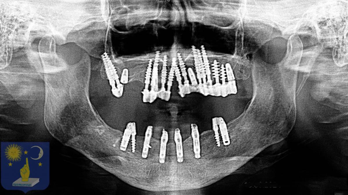 Failed All-on-6 Saved with Basal Implants