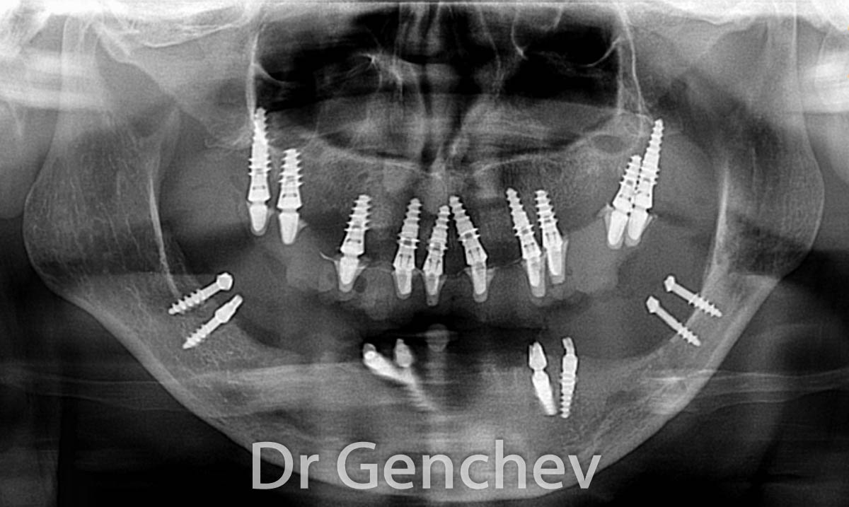 Dr Genchev Lower Jaw Restoration