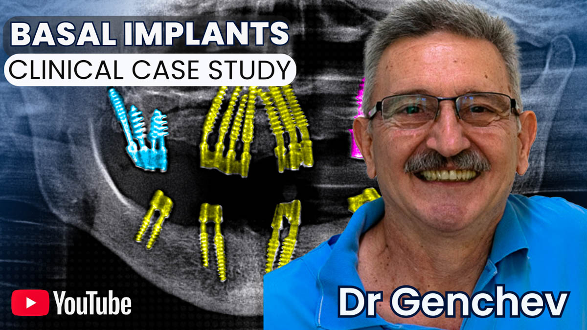 Basal Implants for Edentulism and Bone Atrophy