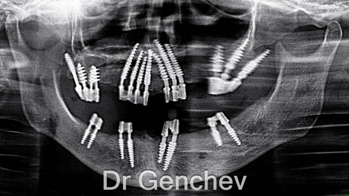 Ihde Dental implants in x-ray